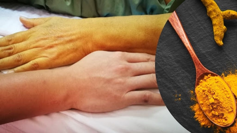 Uống bột nghệ có bị vàng da không? Lưu ý gì khi dùng? 2