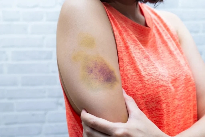 Tiểu cầu thấp có tác hại gì? Uống gì để tăng tiểu cầu 1