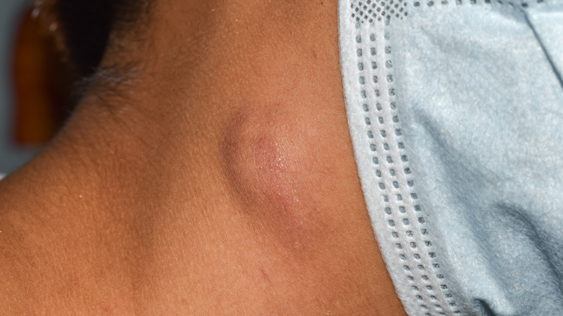 Uống thuốc gì để tiêu hạch? Câu trả lời nằm ở nguyên nhân, không phải ở thuốc