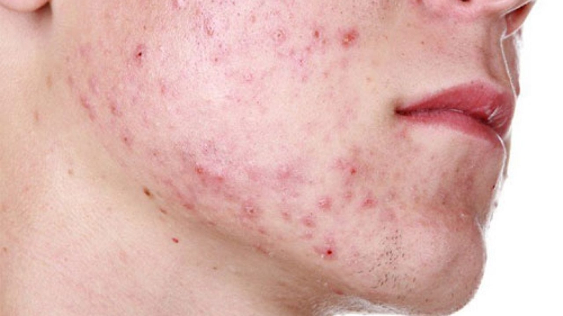 Uống kẽm trị mụn nội tiết có hiệu quả không? 2