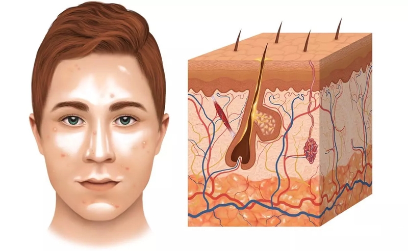 Uống kẽm trị mụn nội tiết có hiệu quả không? 3