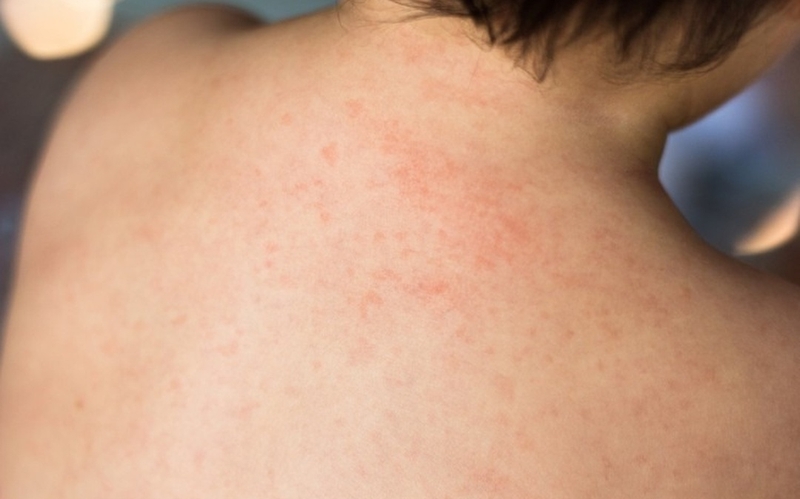 Uống nhiều allopurinol có tốt không? Cần lưu ý gì khi sử dụng? 4