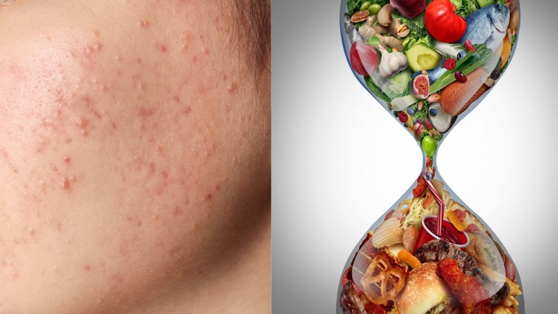 Uống nhiều nước có hết mụn không? Làm gì để hạn chế mụn? 1