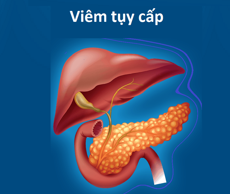Uống nhiều rượu bia gây viêm tụy cấp 1