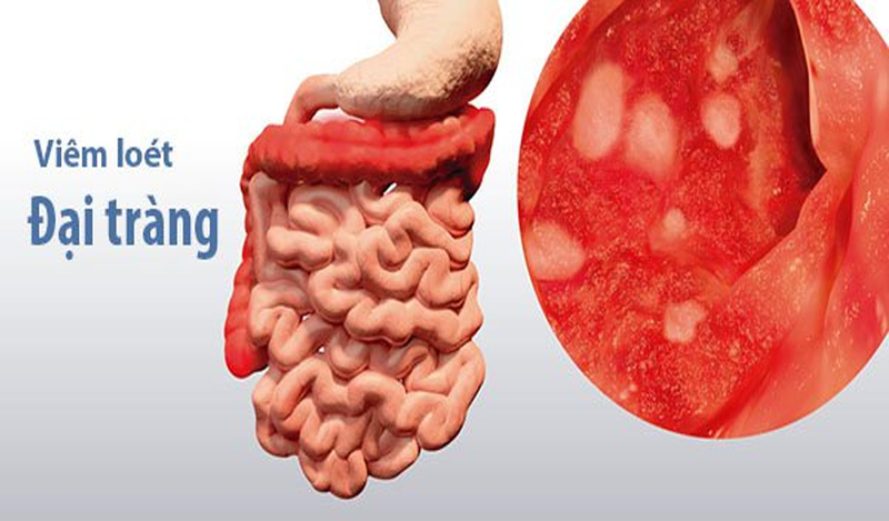 Viêm loét đại tràng là gì?