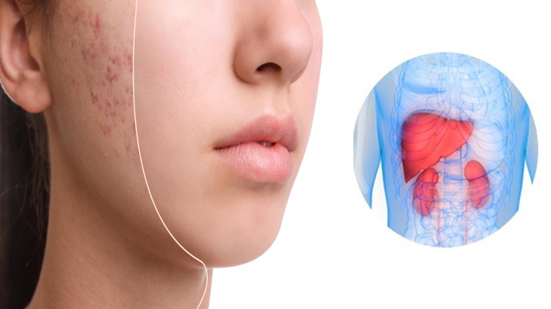 Uống thải độc gan có hết mụn không? 1