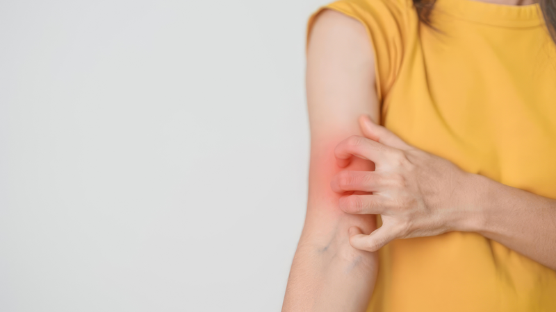 Uống thuốc lao bị nổi mẩn đỏ và mụn là tình trạng khiến nhiều người lo lắng
