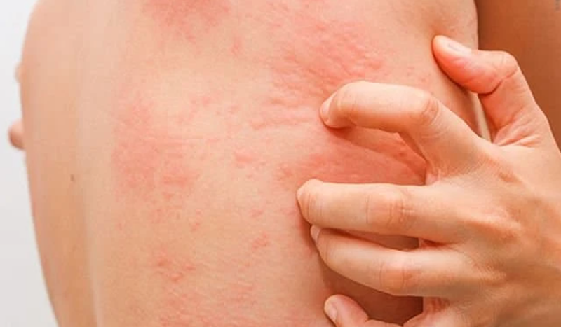 Uống thuốc trị sán chó vẫn bị ngứa phải làm sao? 1