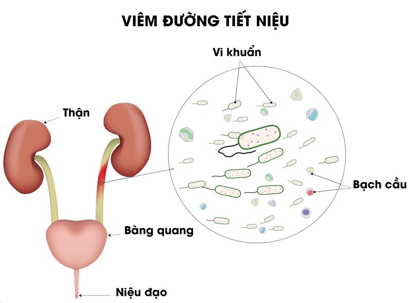 Uống thuốc viêm đường tiết niệu đi tiểu màu xanh có hại không - 1