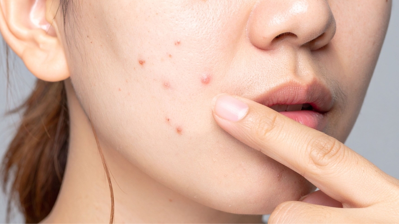 Tinh bột nghệ giúp giảm mụn và làm mờ vết thâm