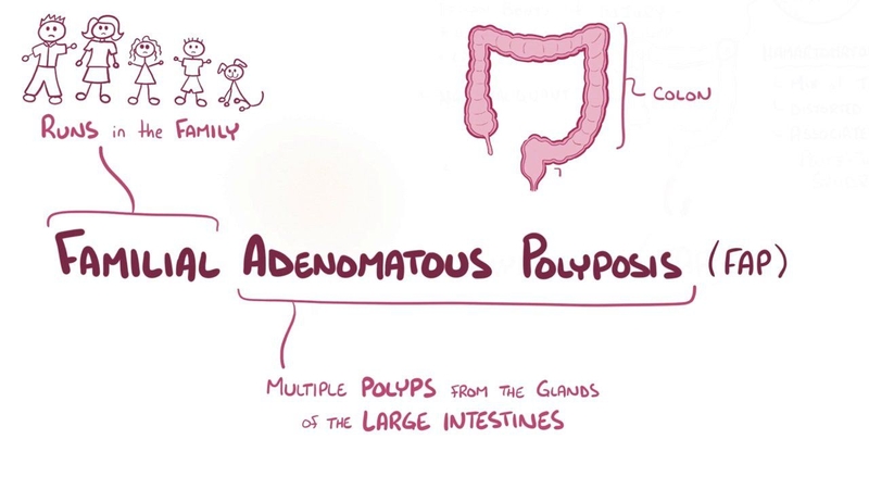 Ung thư đại tràng 4 giai đoạn 1 là gì? Phương pháp điều trị hiệu quả