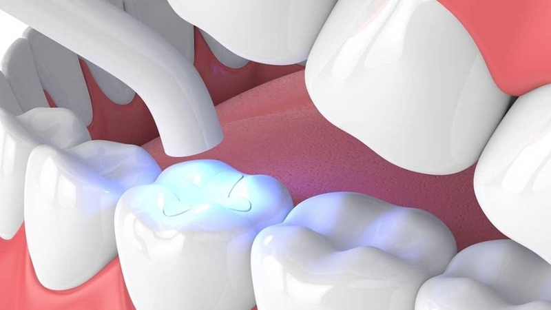 uu-nhuoc-diem-cua-phuong-phap-tram-rang-composite