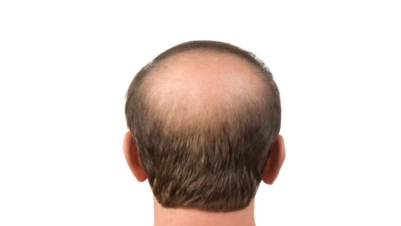 Ưu và nhược điểm của cấy tóc FUE là gì? 2