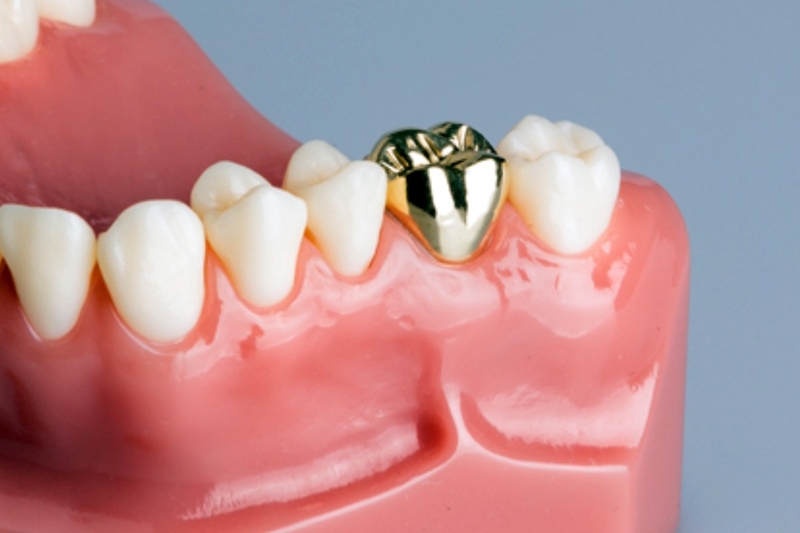 Ưu và nhược điểm của kỹ thuật bọc răng vàng 1