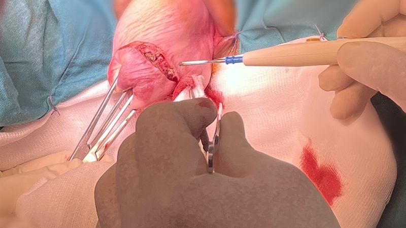 Ưu và nhược điểm của phương pháp phẫu thuật crossen 1