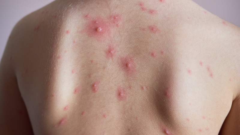 Vắc xin MMRV phòng ngừa cùng lúc 4 bệnh: Sởi, quai bị, rubella, thủy đậu