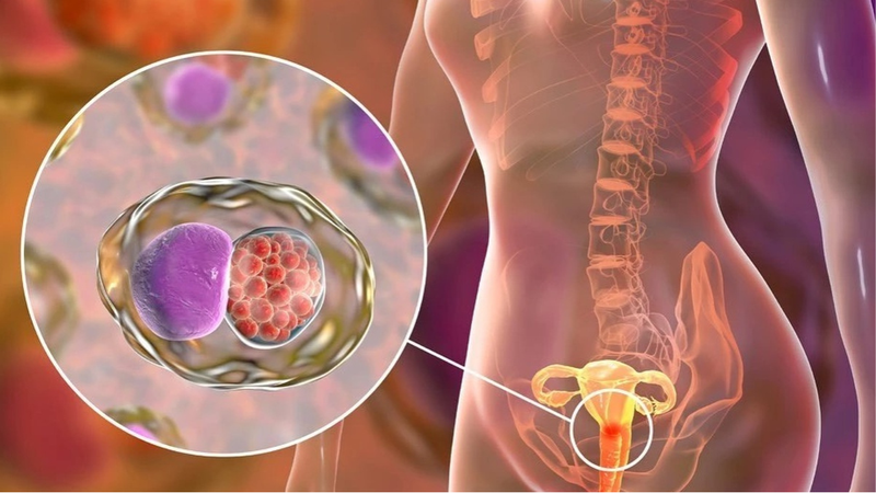 Vắc xin phòng ung thư buồng trứng đầu tiên trên thế giới đang được phát triển tại Anh 1