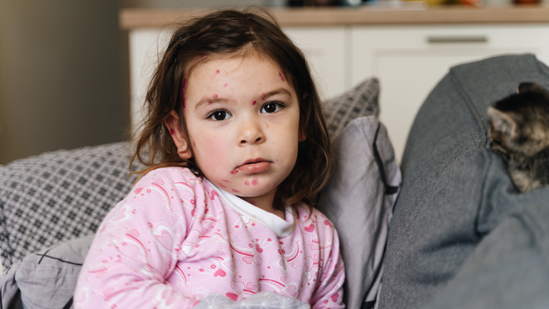 Vắc xin sởi quai bị rubella thủy đậu đóng vai trò đặc biệt quan trọng trong phòng ngừa các bệnh truyền nhiễm