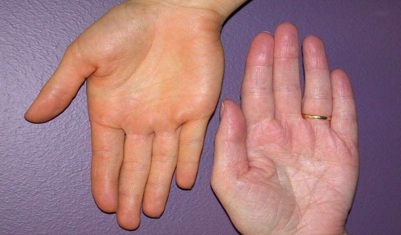 Vắc-xin Stamaril: Giải pháp phòng ngừa hiệu quả bệnh sốt vàng 2