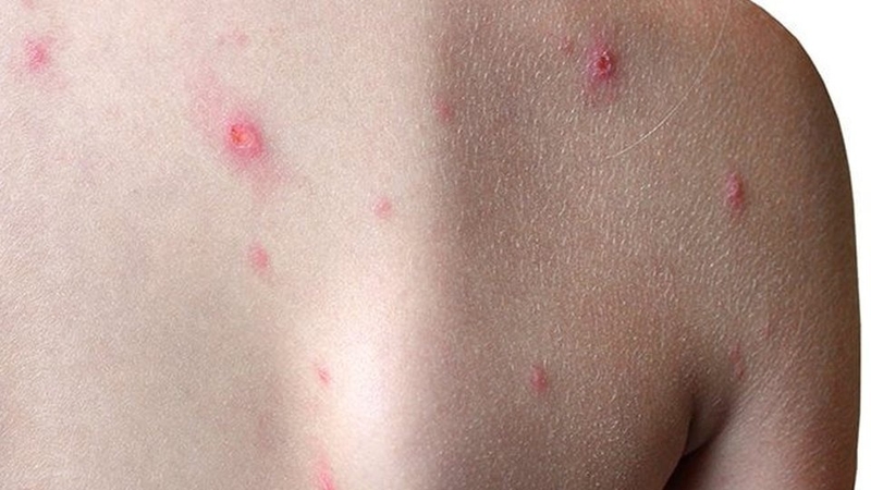 Cách phòng bệnh và thông tin về vaccine phòng bệnh đậu mùa khỉ 1