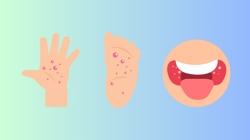 Vaccine tay chân miệng đã có ở Việt Nam chưa? 1