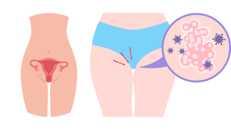 Vaginitis là gì? Tìm hiểu về căn bệnh phái nữ thường gặp 1