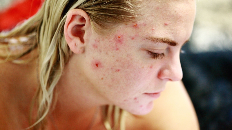 Người dễ nóng trong nên ăn vải vừa phải vì ăn nhiều có thể làm nặng thêm các triệu chứng như mụn, rôm sảy, nhiệt miệng