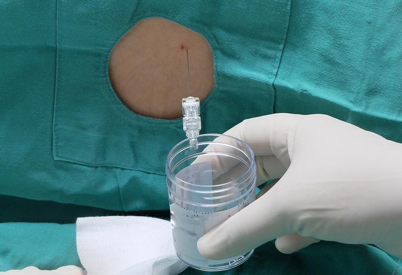 Vai trò của dịch não tủy là gì? Mục đích xét nghiệm dịch não tủy để làm gì? 1