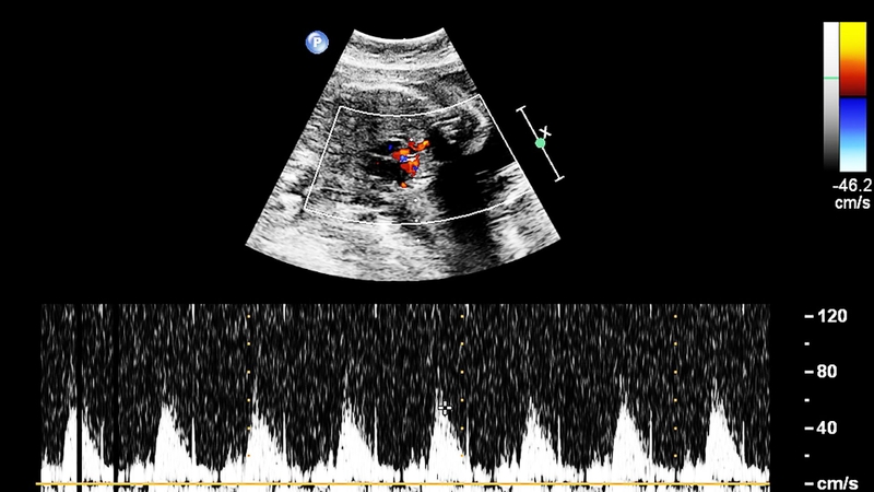Vai trò của phương pháp sàng lọc tim bẩm sinh bằng SpO2 trong phát hiện sớm bệnh lý 1