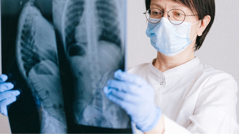 Xẹp đốt sống trên X-quang là dấu hiệu điển hình của loãng xương tiến triển