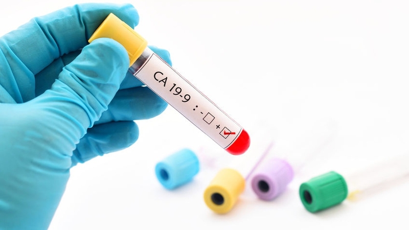 Vai trò của xét nghiệm CA 19-9 và ý nghĩa trong chẩn đoán ung thư tụy 2