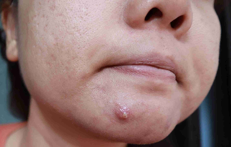 Vấn đề da liễu: Tìm hiểu về mụn viêm bị chai1