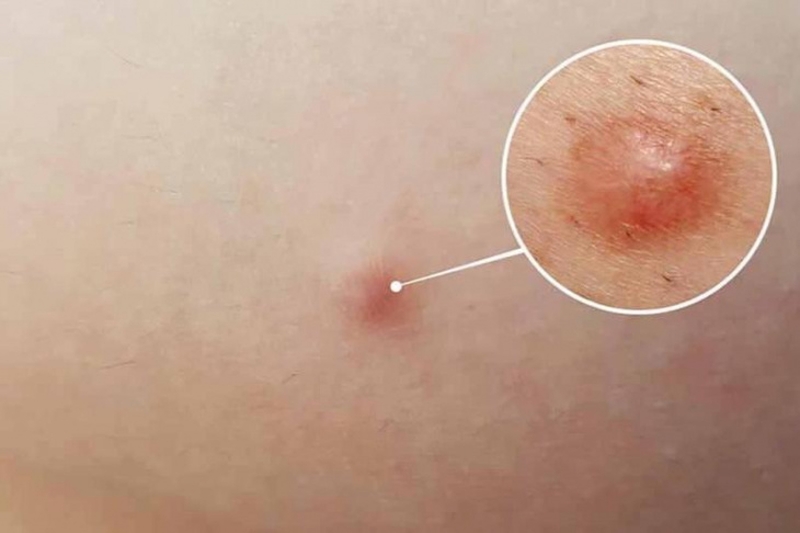 Vấn đề da liễu: Tìm hiểu về mụn viêm bị chai2