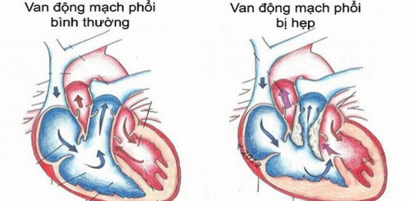 Hẹp van động mạch phổi là tình trạng đầu ra động mạch phổi bị thu hẹp