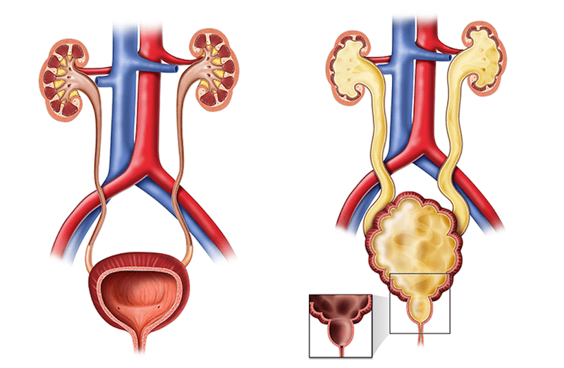 Van niệu đạo sau: Nguyên nhân và cách điều trị 2