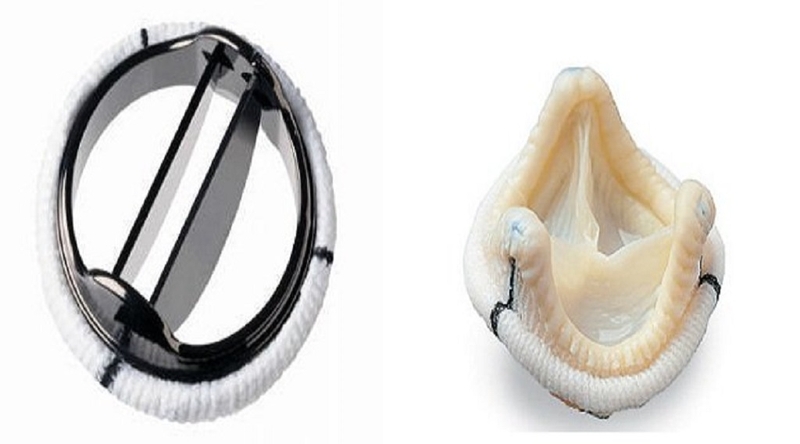 Van tim nhân tạo là gì? Cách chọn van tim nhân tạo phù hợp nhất 3