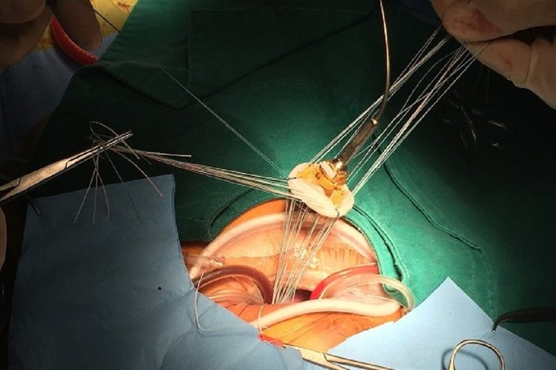 Van tim nhân tạo là gì? Cách chọn van tim nhân tạo phù hợp nhất 4