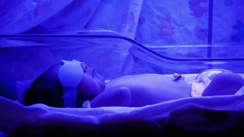 Vàng da tán huyết là gì? Nguyên nhân, triệu chứng và cách điều trị 7