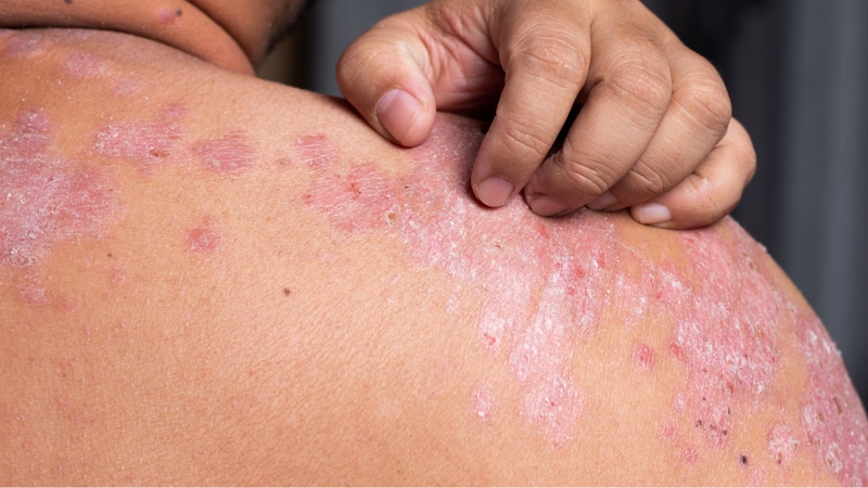 Vảy nến có ngứa không được nhiều người bệnh quan tâm