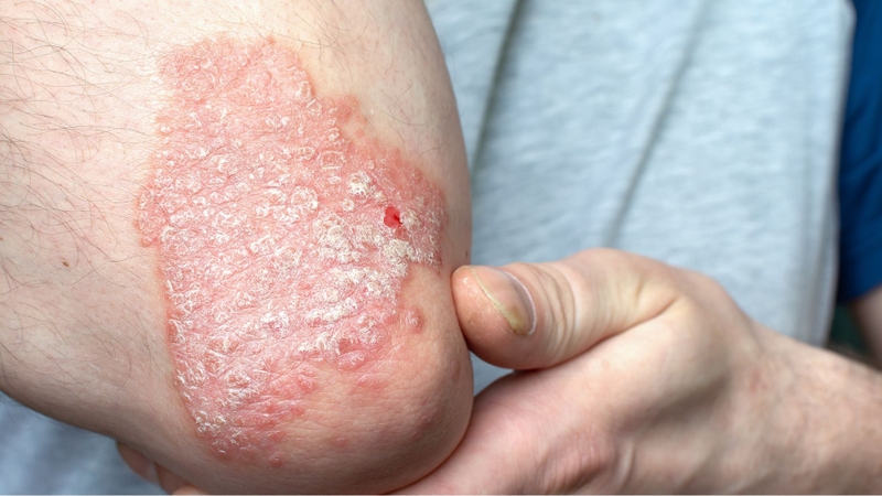 Mảng phát ban không đồng đều là biểu hiện thường thấy ở bệnh vảy nến