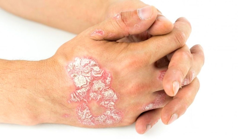 Vảy nến thể mảng có lây không? Có nguy hiểm không? 1