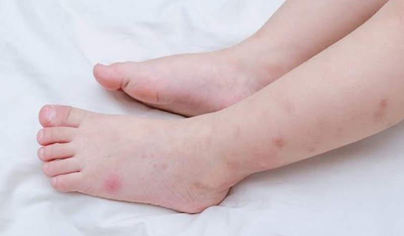 Cần thận trọng khi ve cắn trên da