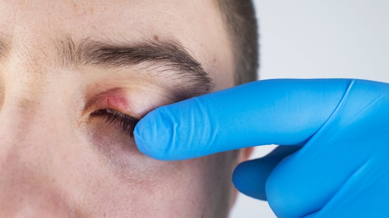 Giữ vệ sinh mí mắt đúng cách để bảo vệ đôi mắt khỏe mạnh mỗi ngày
