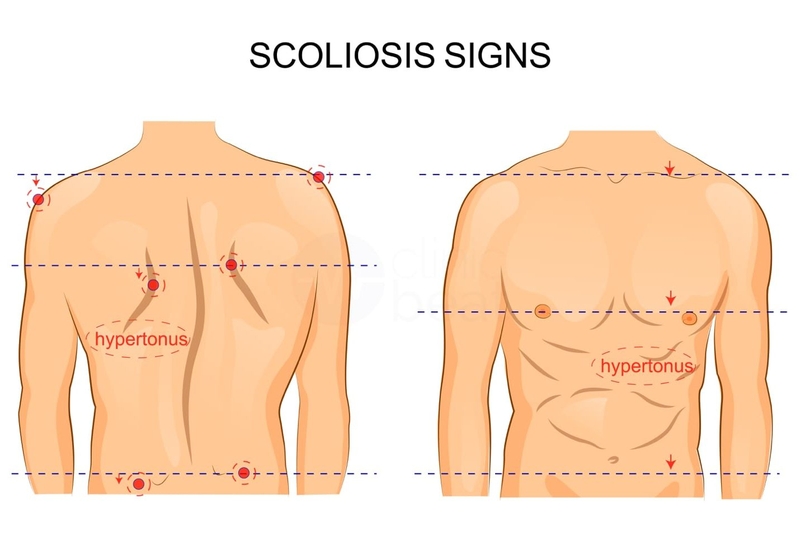 Vẹo cột sống tự phát là gì? Những vấn đề cần biết về vẹo cột sống tự phát 1