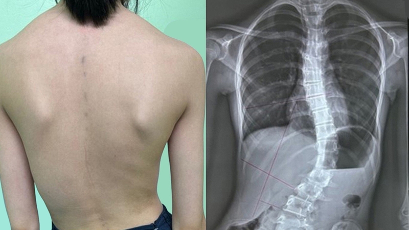 Lo lắng vẹo cột sống tự phát ở trẻ em 1