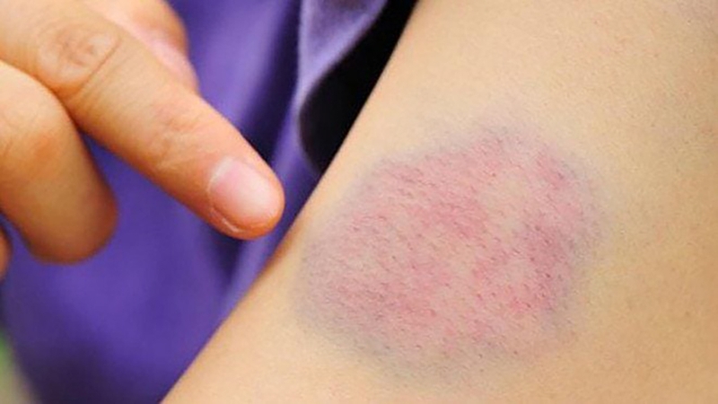 Vết bầm tím bao lâu thì hết? Nguyên nhân và cách xử lý 1