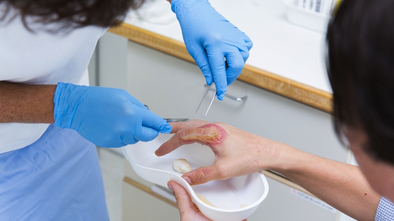 Vết bỏng bị nhiễm trùng: Biểu hiện và cách điều trị 5