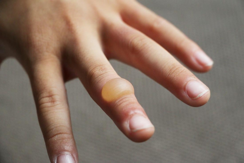 Vết bỏng bị phồng nước bao lâu thì khỏi? Cách chăm sóc vết bỏng 1