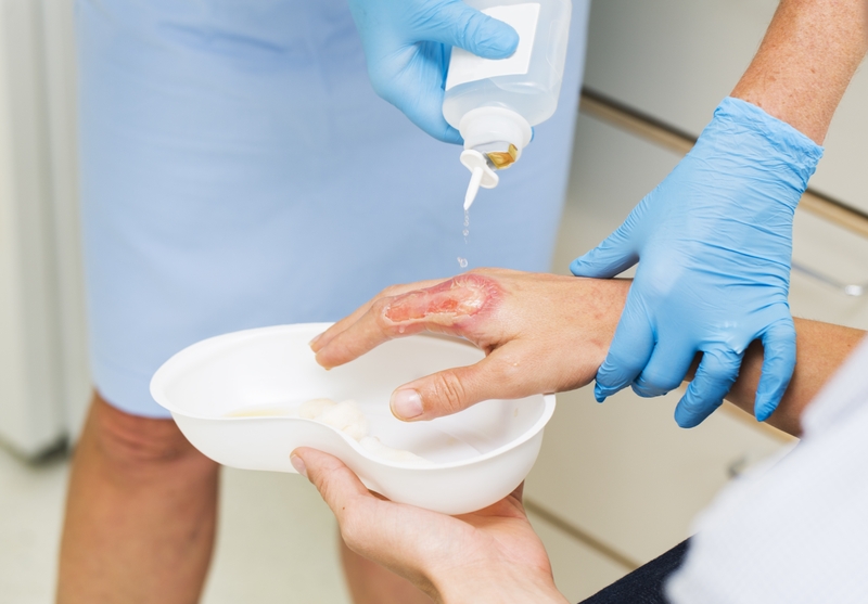 Vết bỏng bị phồng nước bao lâu thì khỏi? Cách chăm sóc vết bỏng 2