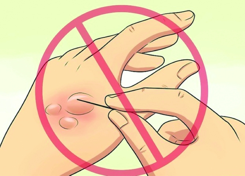 vet-bong-bi-phong-nuoc-phai-xu-ly-nhu-the-nao 2.jpg